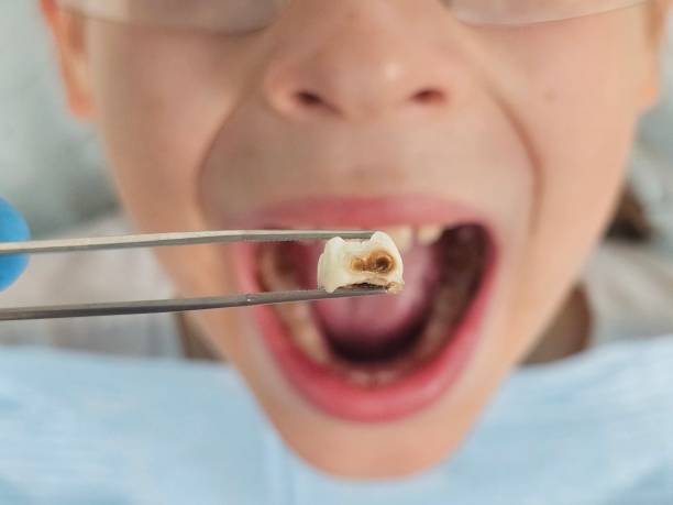 Best Emergency Tooth Extraction in Reinholds, PA